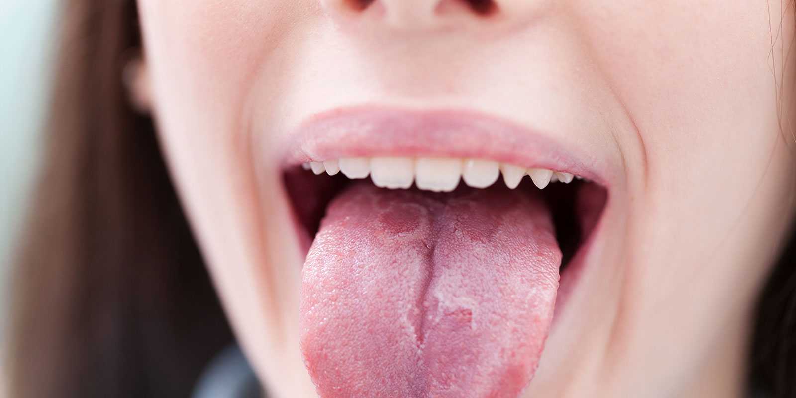 Que Es La Lengua Geografica Infinity Dental