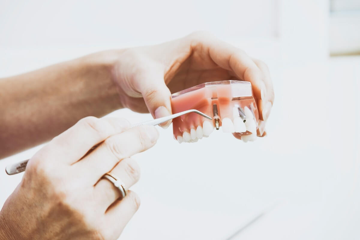 Como Es El Postoperatorio De Los Implantes Dentales
