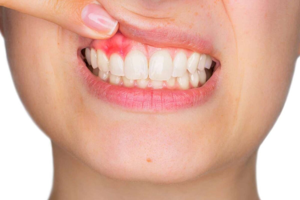 La Periodontitis Incrementa El Riesgo De Fallecer En Pacientes De Covid 19